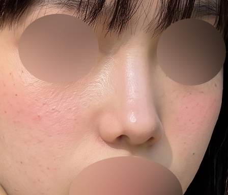 코재수술 수술후