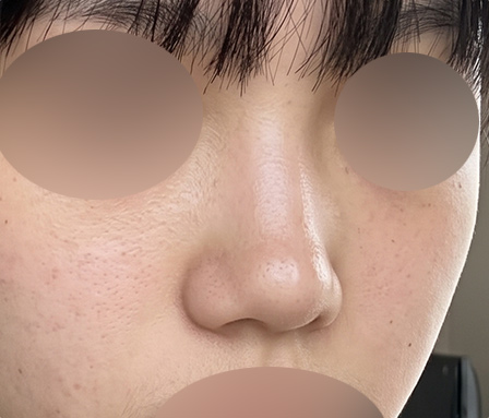 코재수술 수술전